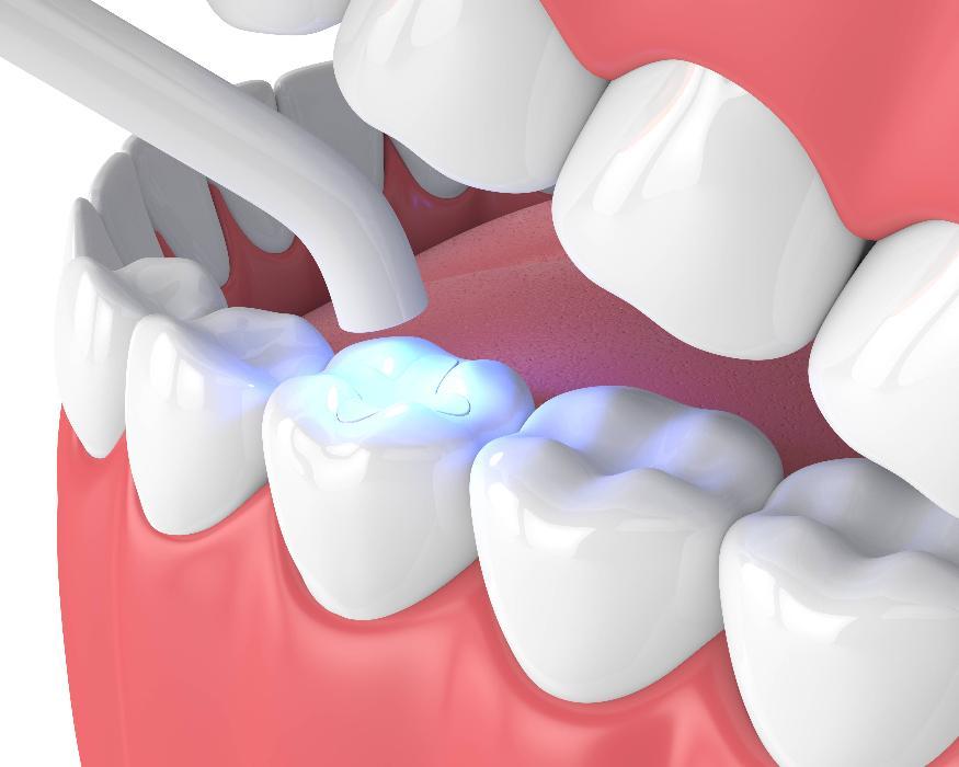 Digital graphic of tooth colored filling restoring cavity