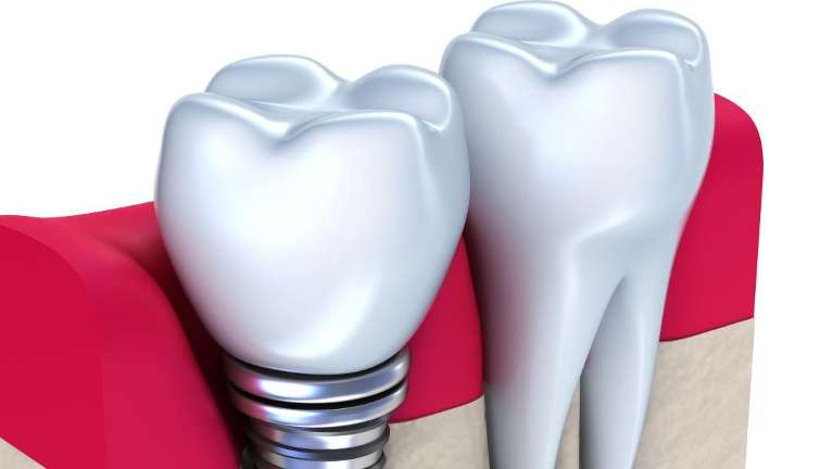 dental implant illustration with screw