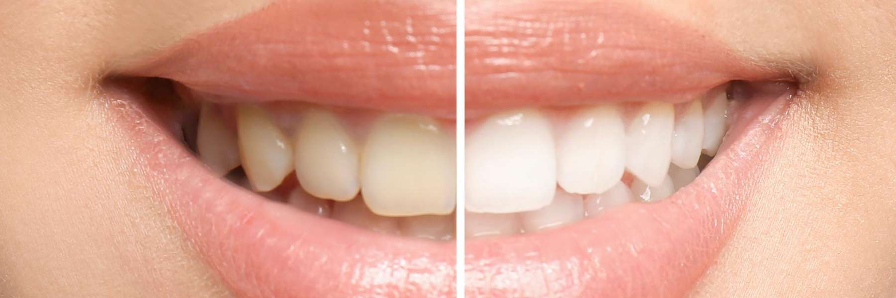 before and after teeth whitening