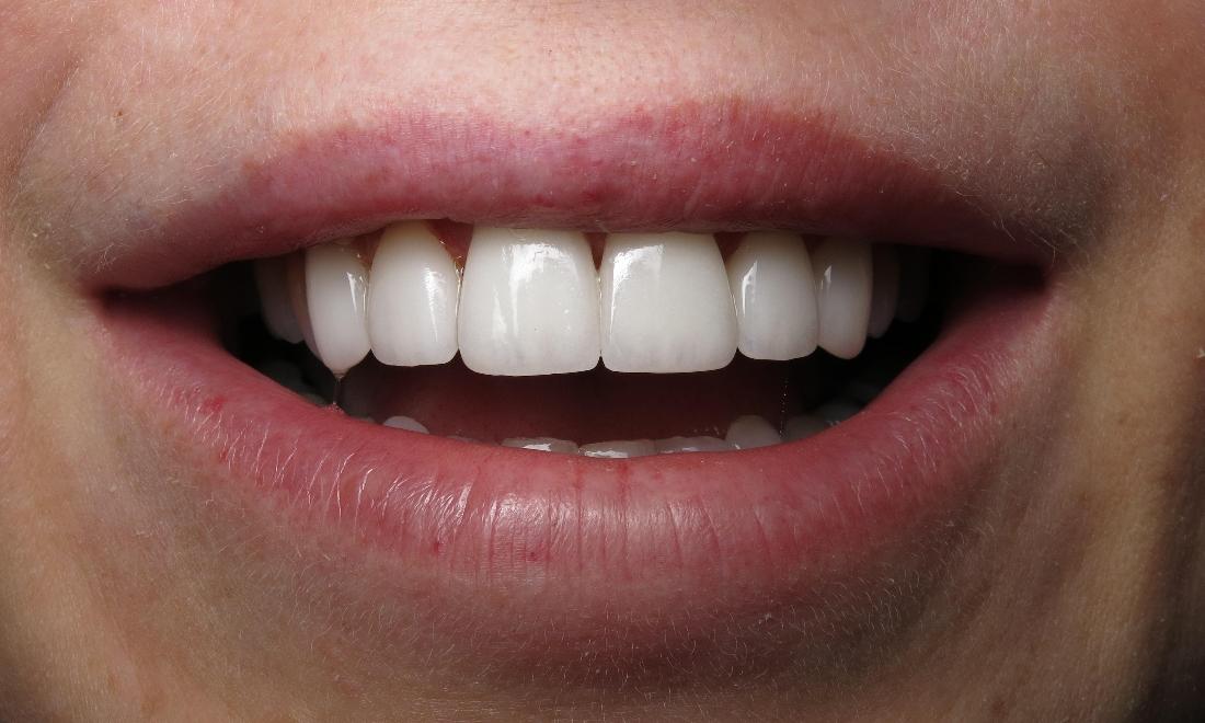 Results from cosmetic dentistry procedure for veneers in 70605