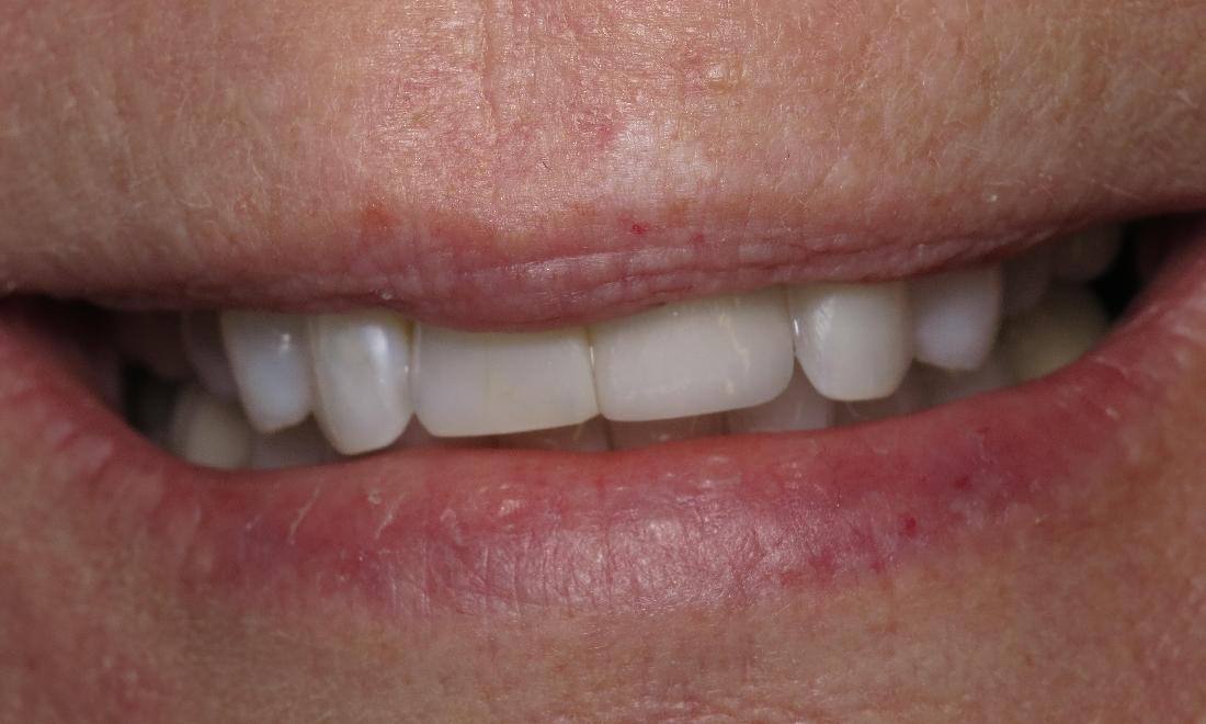 Close up of results from dental implant procedure in Lake Charles LA
