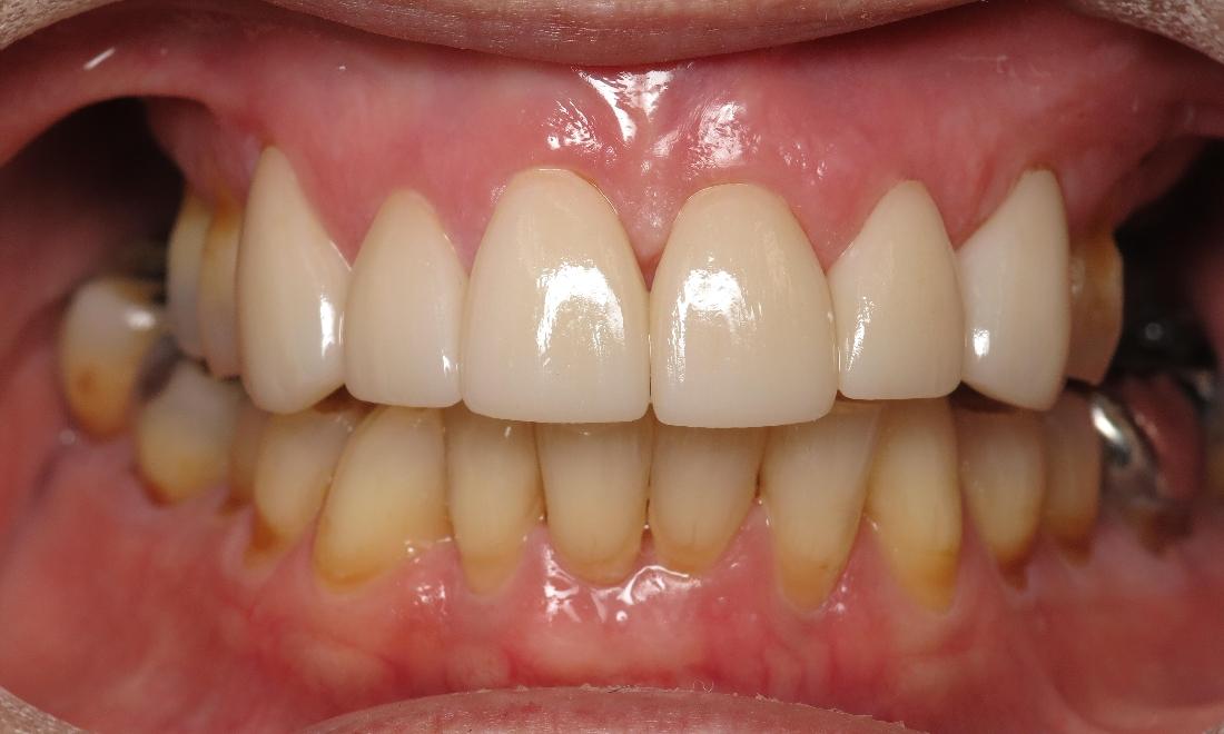 Results from procedure for porcelain veneers in Lake Charles LA