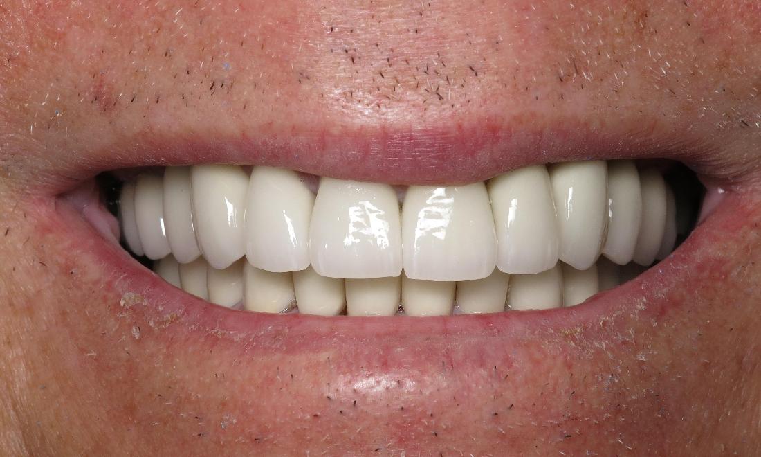 Results from smile makeover with dental crowns in Lake Charles LA