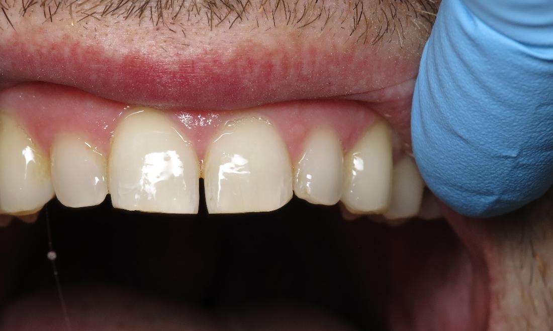 Patient results from deep dental cleaning in Lake Charles LA