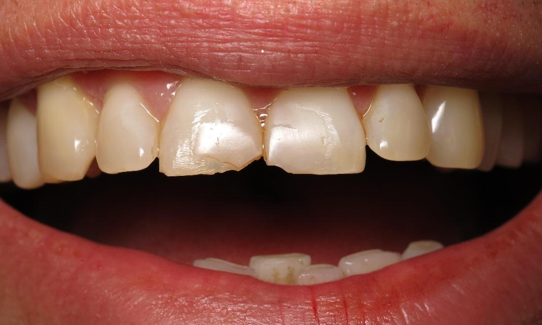 Close up of dental patients smile before CEREC dental crowns in Lake Charles