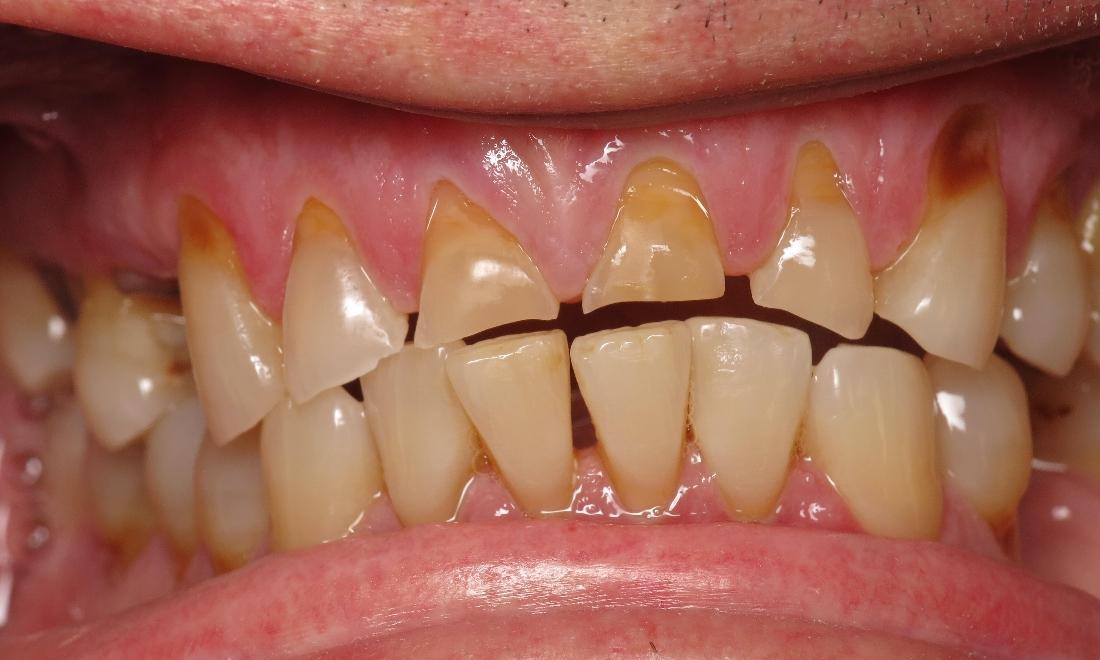 Close up of worn down teeth from teeth grinding near Lake Charles LA