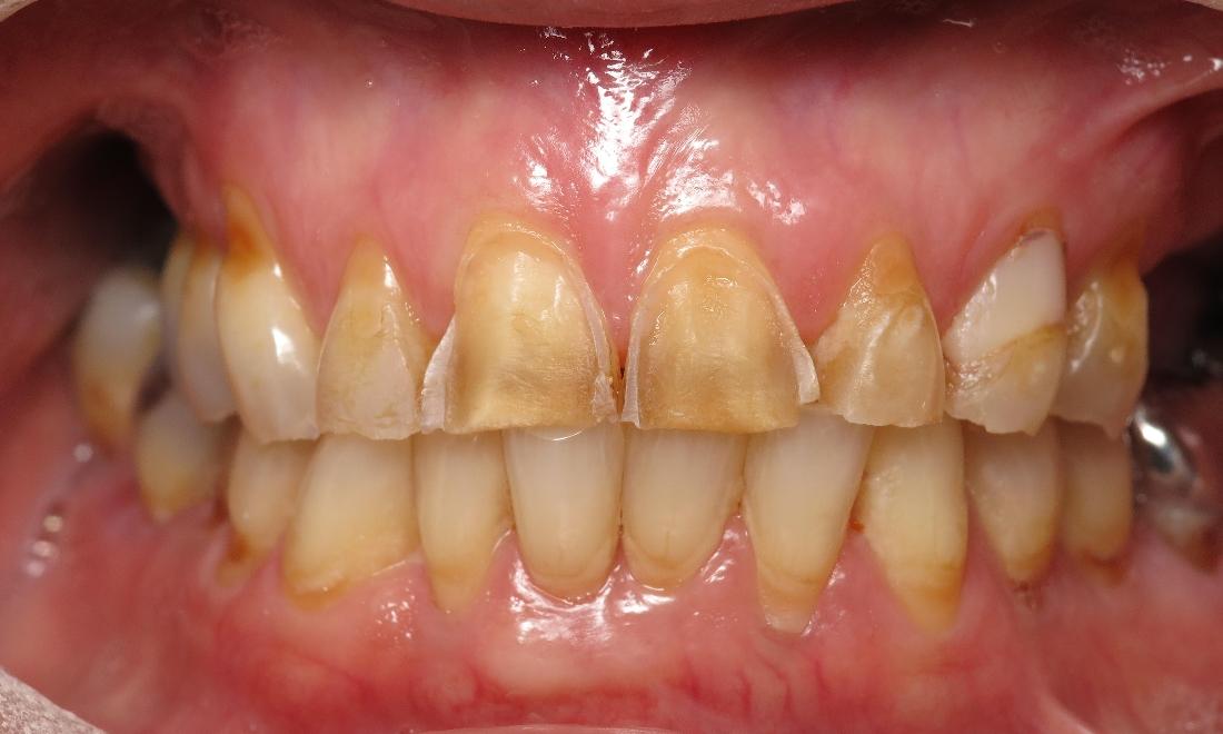 Close up of dental patients severely stained and worn down teeth at dentist near 70607