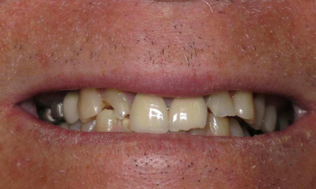 Close up of uneven and discolored teeth at Lake Charles dentist office