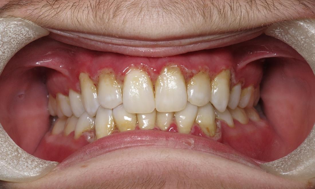 Close up of patient with gingivitis at dentist near 70607