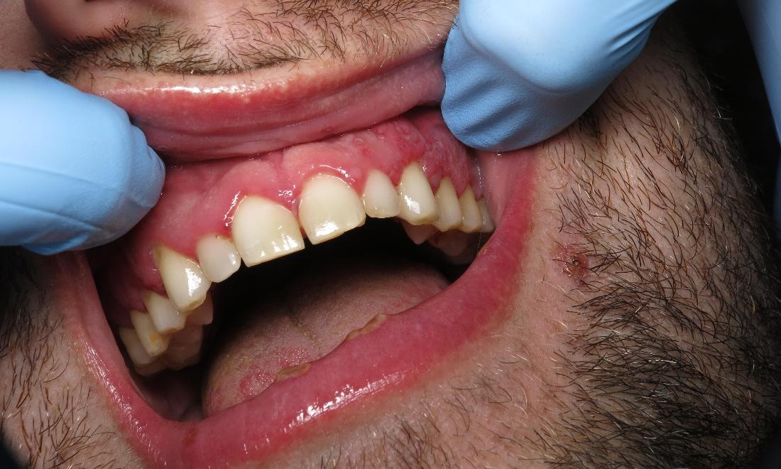 Patients smile showing signs of gum disease at dentist near 70607