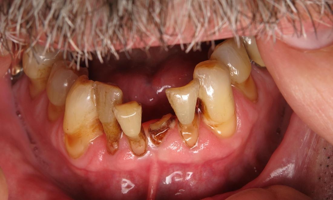 Close up of severely worn down and decayed teeth at Dr Scott Hannaman DDS