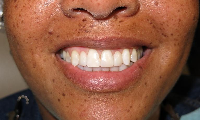 Results from smile makeover with dental crowns at 70605 dentist office