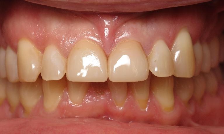 Broken-Tooth-CEREC-Crown-After-Image