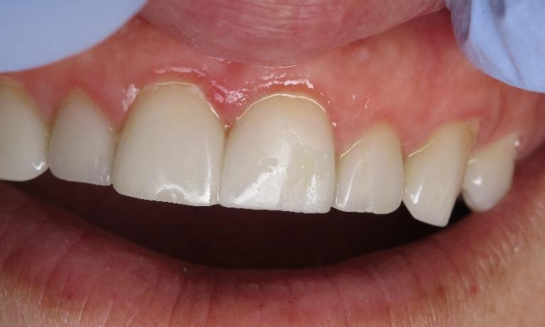 Results from porcelain veneers restoration by Dr Scott Hannaman DDS