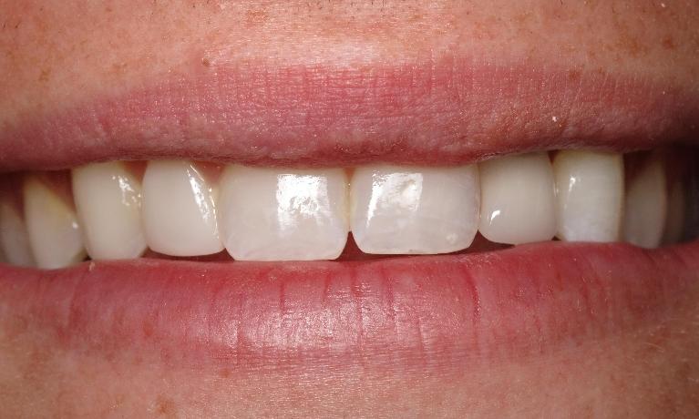 Dental-Implant-After-Image