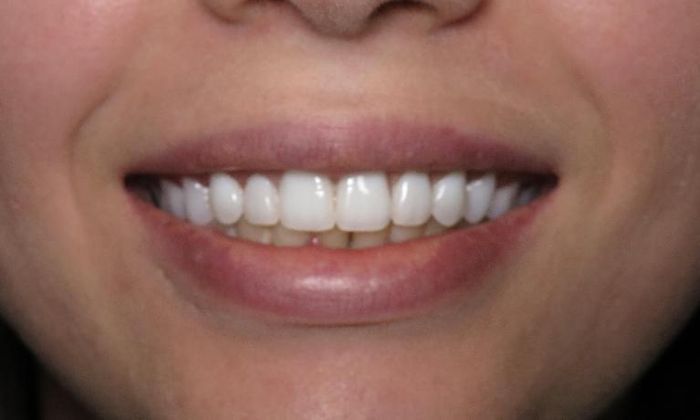 Dentures-After-Image