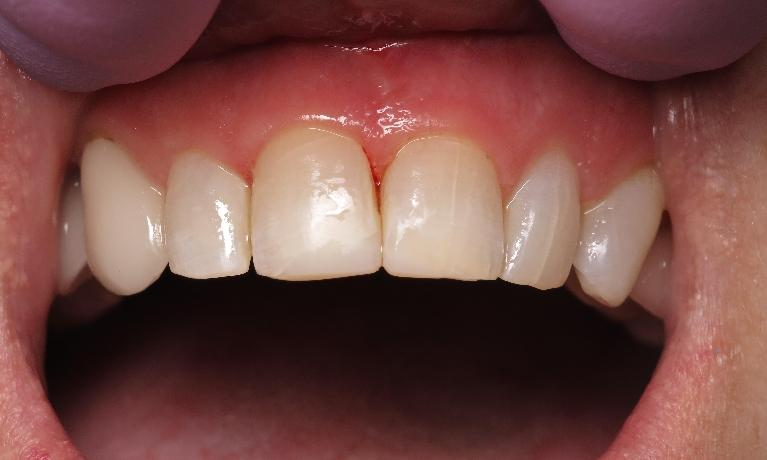 Results from dental bonding procedure to repair chipped teeth in 70605
