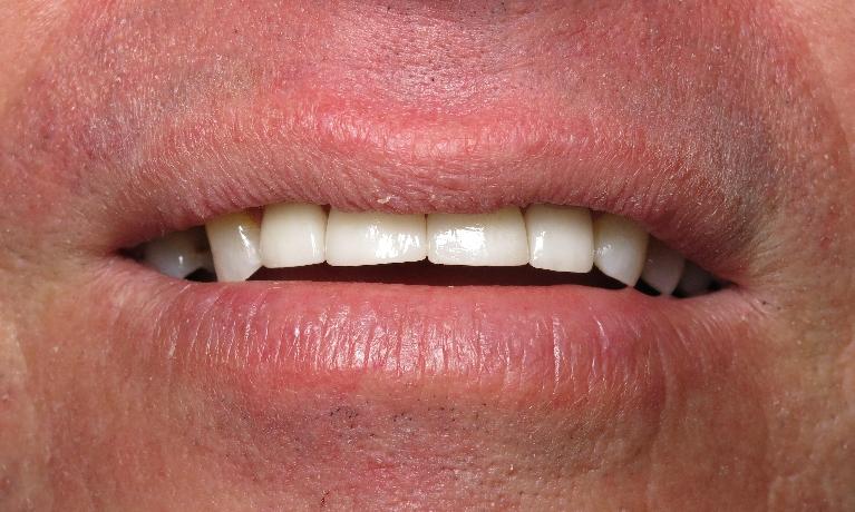 Patients smile after procedure for dental crowns in Lake Charles LA