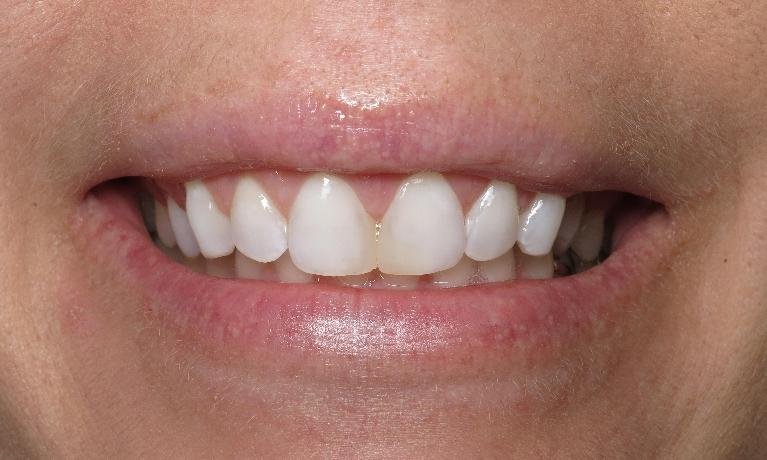 Results from cosmetic gum surgery at Lake Charles cosmetic dentist office
