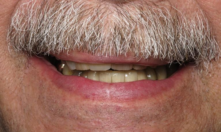 Patients smile after placement of fixed dental bridge in 70605