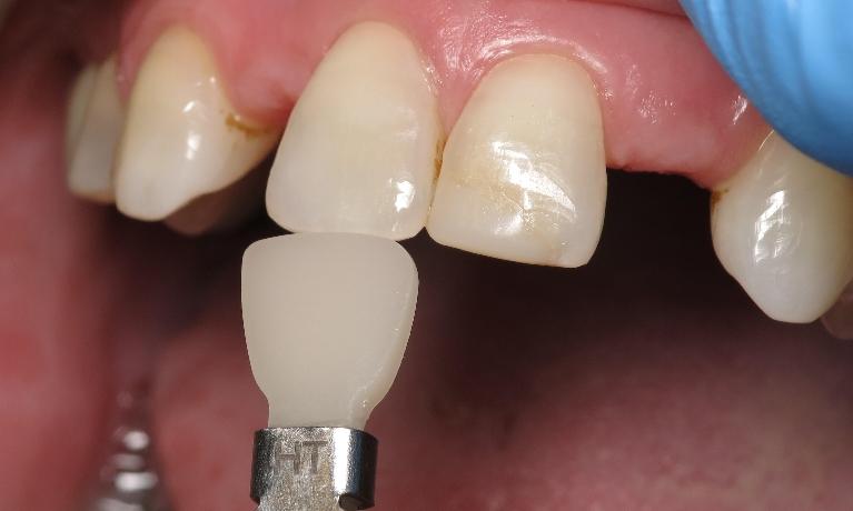 Close up of patients top gums with missing teeth near 70607