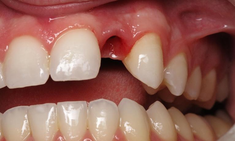 Dental-Implant-Before-Image