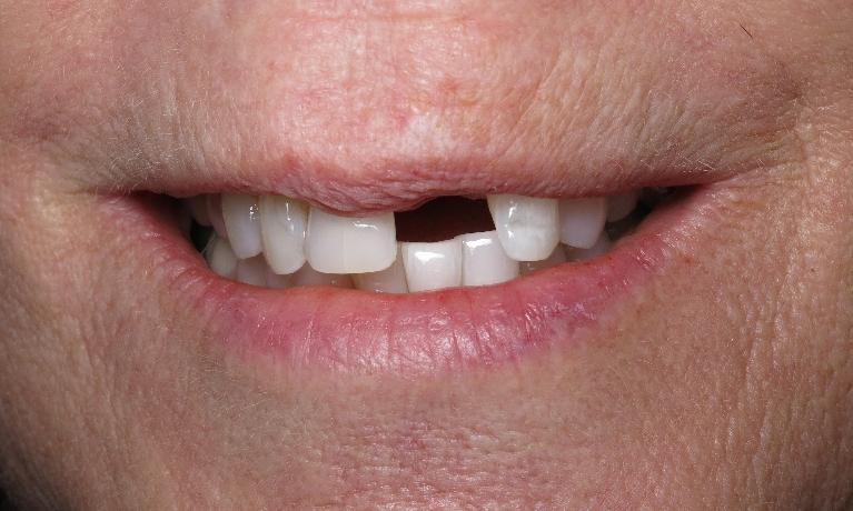 Dental-Implant-Before-Image