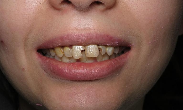 Dentures-Before-Image