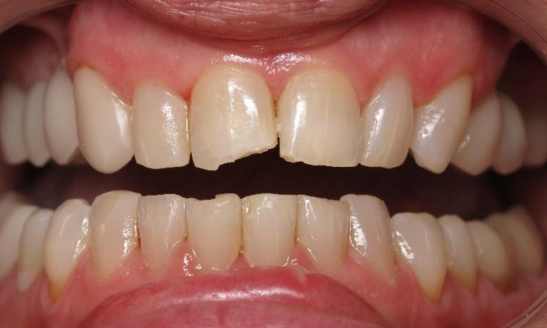 Patient with chipped front teeth from dental emergency near Lake Charles