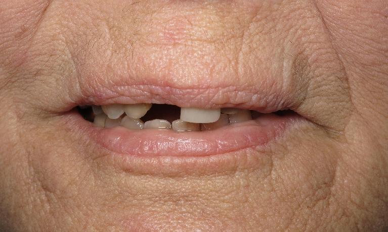 Dental patients smile showing missing teeth at Lake Charles dentist office