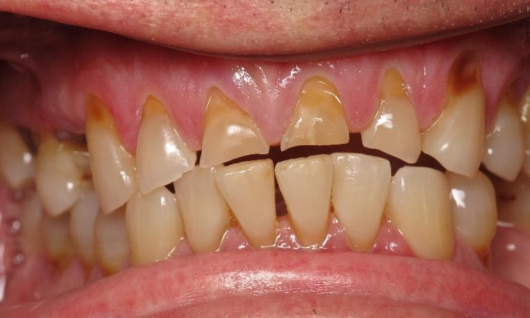 Close up of worn down teeth from teeth grinding near Lake Charles LA