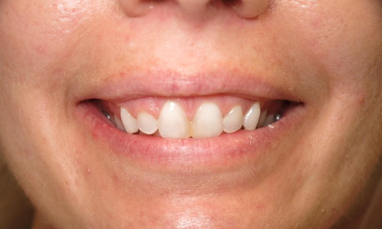 Dental patients smile before excess gum removal at 70605 dental office
